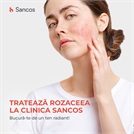 Tratează rozaceea la Clinica Sancos