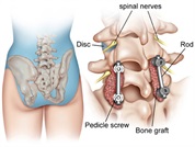 Fuziunea spinală — operațiile de fixare a coloanei vertebrale, care pot ameliora durerile cronice de spate