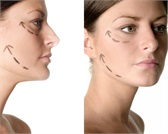 Liftingul facial chirurgical versus liftingul cosmetologic (thread lifting).  Ce alegi pentru a-ți întineri pielea