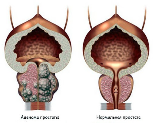 cu o erecție, prostata se mărește)