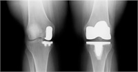 Endoprotezarea parțială a genunchiului la Medpark